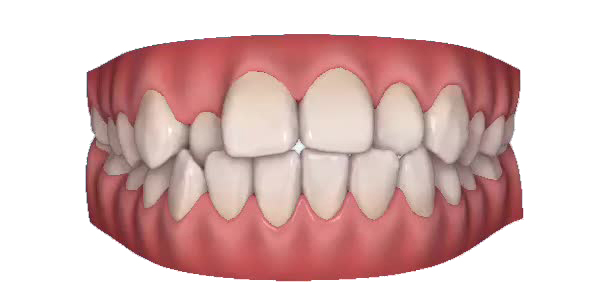 Crossbite — week 1