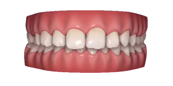Deep bite — week 1