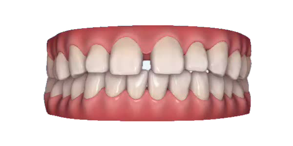 Gapped teeth — week 1