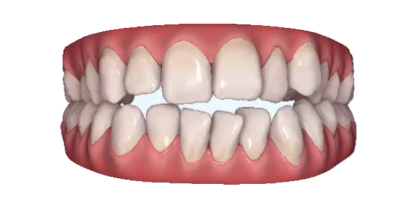 Open bite — week 1