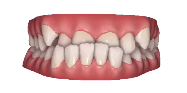 Underbite — week 1